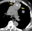 Axial images from an unenhanced chest CT at the level of the pulmonary trunk demonstrate an anterior <strong>mediastinal mass(arrows)</strong> with aggressive features suggested by the coarse calcifications within it and the irregular lobulated margin with the lung, suggestive of pulmonary invasion. In addition, there is a pulmonary nodule in the left upper lobe, confirmed by biopsy to represent a metastasis. 